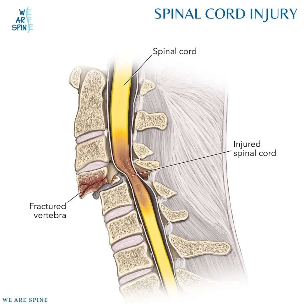 Perkembangan kedokteran regeneratif membuka peluang baru dalam penanganan cedera saraf tulang belakang (spinal cord injury/SCI) dan stroke.